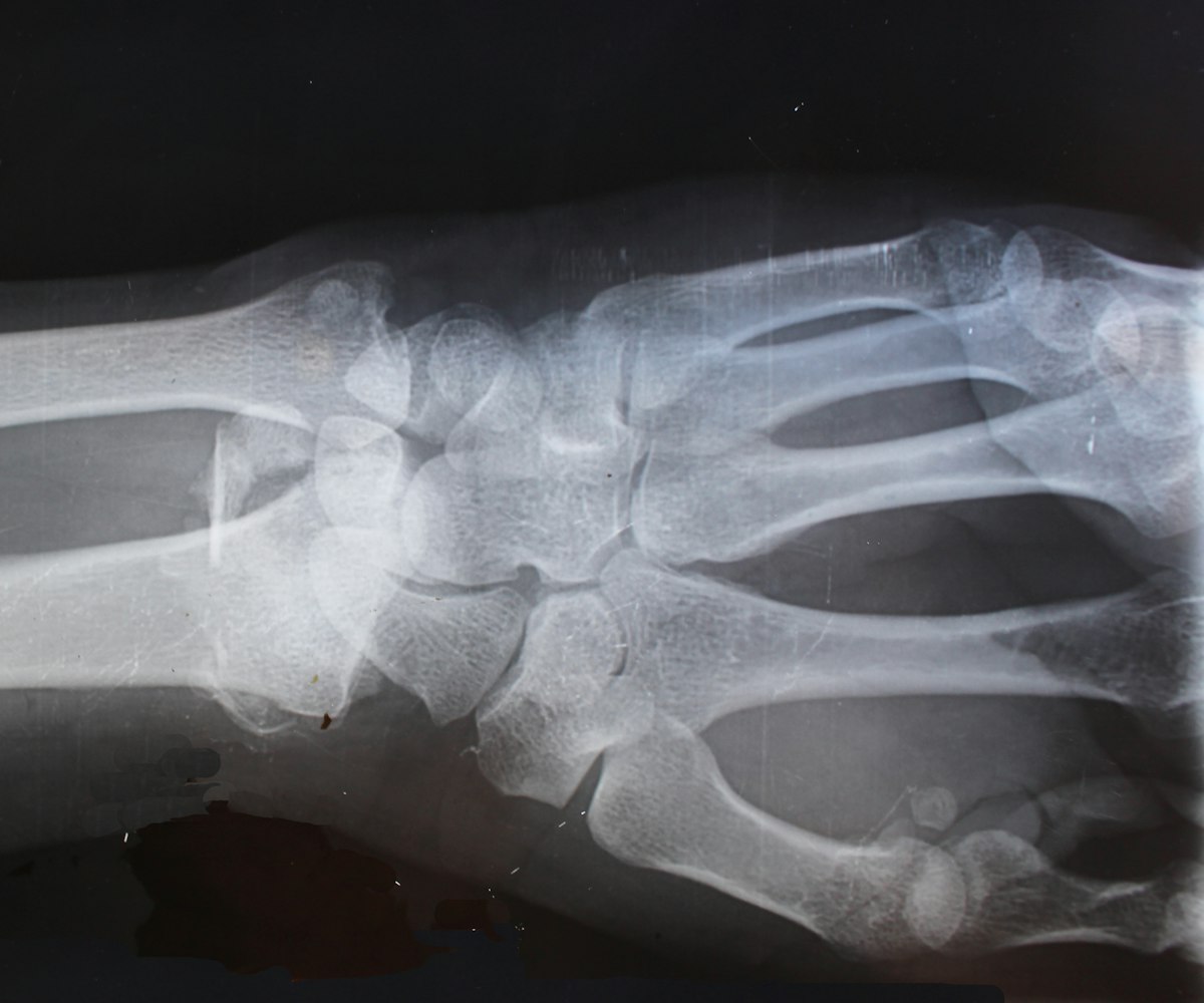 Radiografía de hueso para valoración en Traumatología y Ortopedia